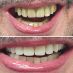 Over implants and titanium bar, retained dentures
