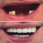 Before and after photo of complete upper denture and cast partial lower denture. 